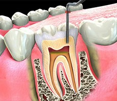 ROOT CANALS