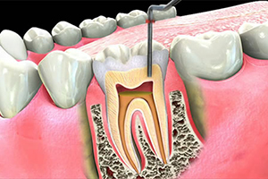 ROOT CANALS