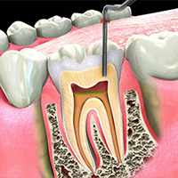 my dentist brookline root canal