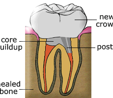 POST AND CORE BUILD UP