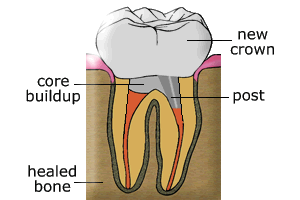 POST AND CORE BUILD UP