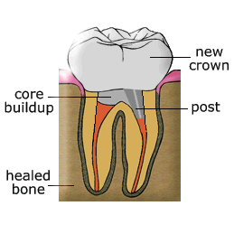 My Dentist Brookline Post and Core Build Up