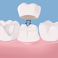 My Dentist Brookline Crowns