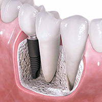 dental implants brookline